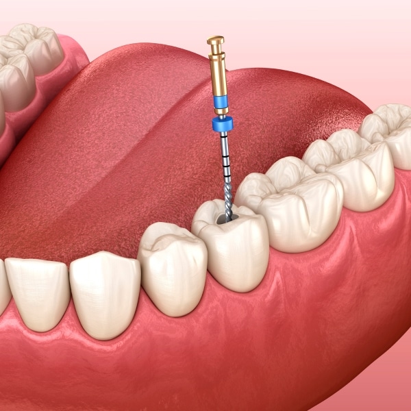Alpharetta Endodontics Georgia