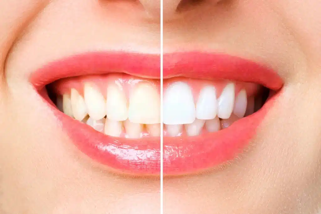 before and after teeth whitening alpharetta