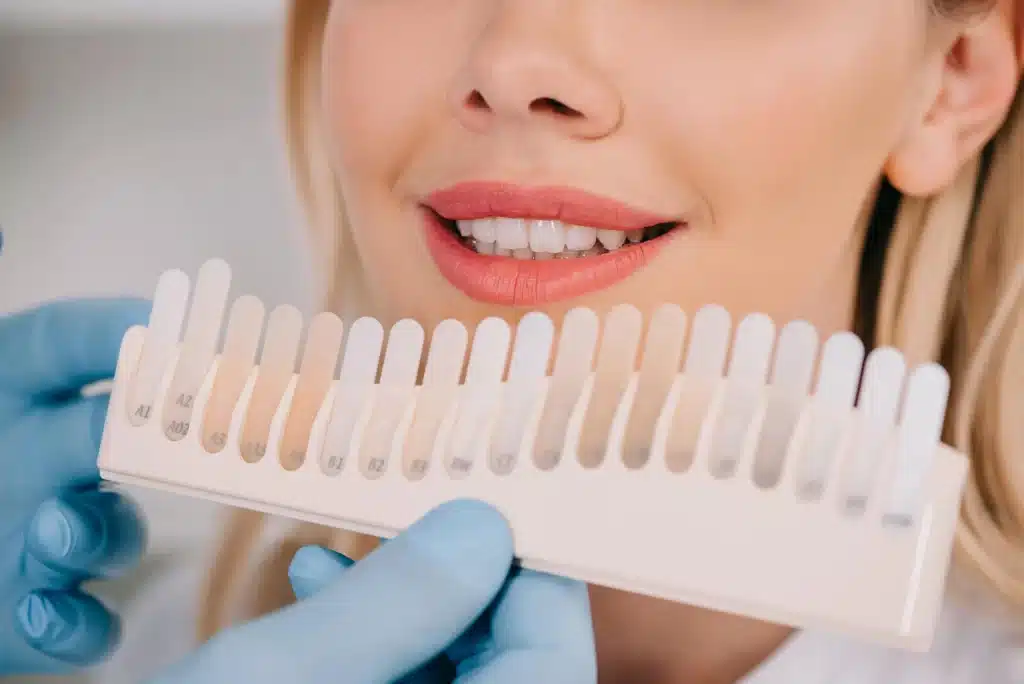 before teeth whitening alpharetta
