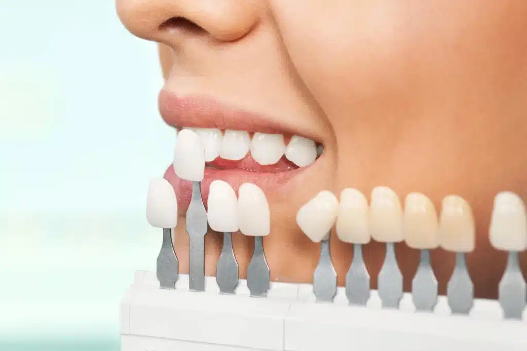 cosmetic dentist alpharetta prepares patient for veneer application